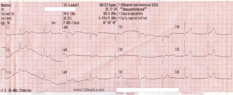 MedSnack #4 - STEMI OR NOT? - Stanford EMS Prehospital Education Platform